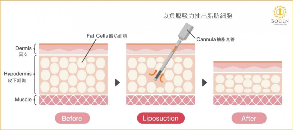 傳統抽脂,抽脂原理,抽脂,博恩妍