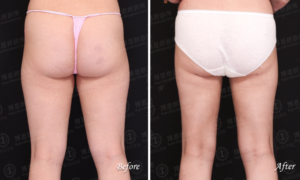 超音波抽脂改善大腿脂肪,超音波抽脂,ultra Z黃金Z波,博恩妍