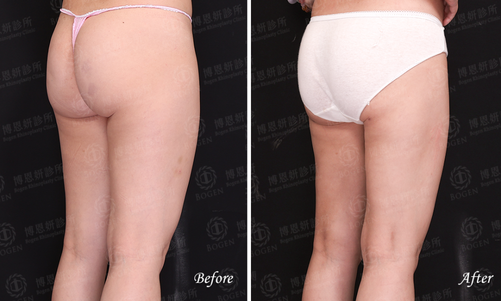超音波抽脂改善大腿脂肪,超音波抽脂,ultra Z黃金Z波,博恩妍
