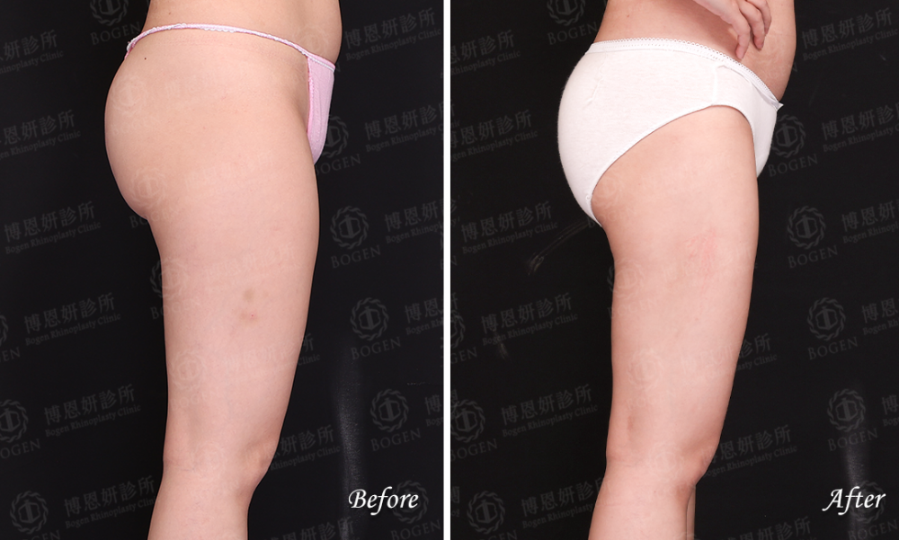 超音波抽脂改善大腿脂肪,超音波抽脂,ultra Z黃金Z波,博恩妍
