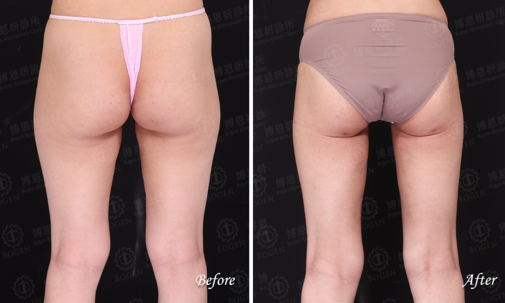 超音波抽脂改善大腿脂肪,超音波抽脂,威塑抽脂,博恩妍