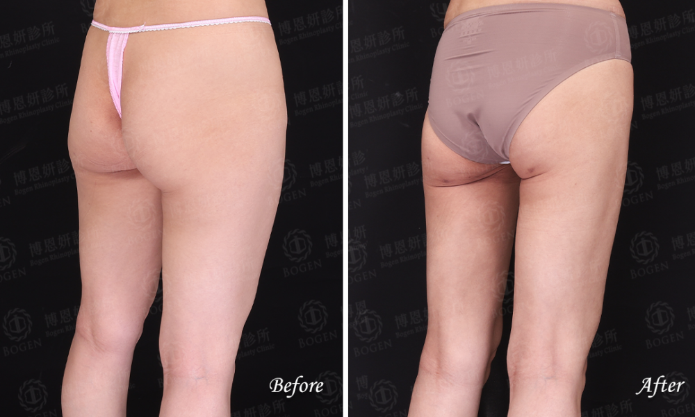 超音波抽脂改善大腿脂肪,超音波抽脂,威塑抽脂,博恩妍