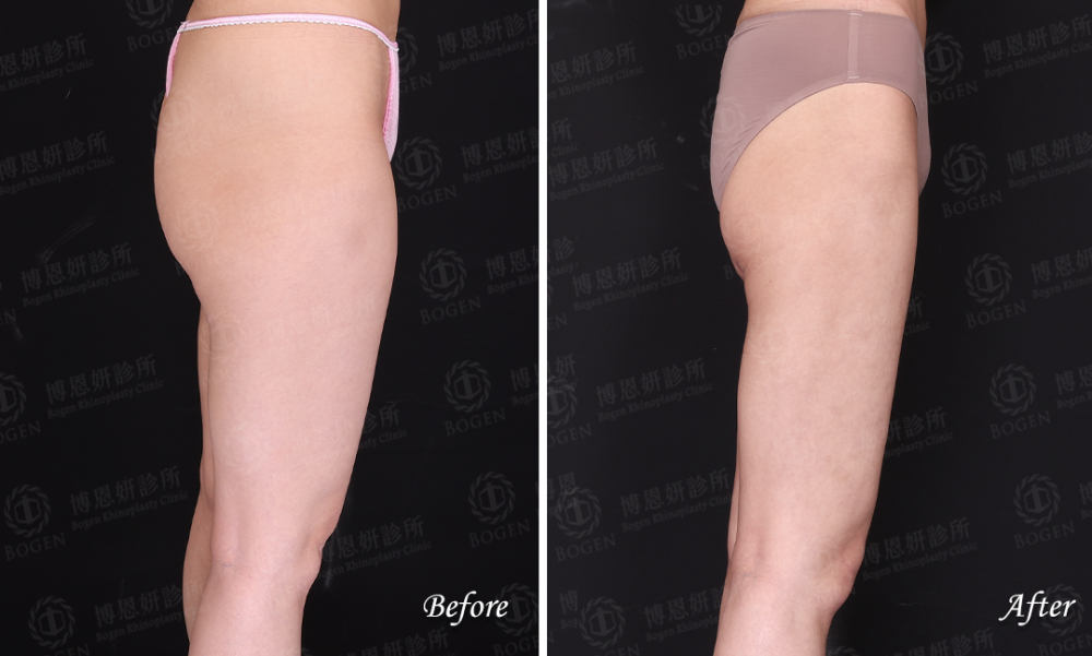 超音波抽脂改善大腿脂肪,超音波抽脂,威塑抽脂,博恩妍