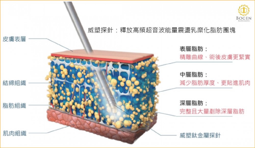 威塑超音波抽脂原理,威塑超音波抽脂,博恩妍