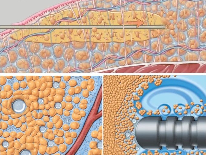 威塑超音波抽脂原理,威塑抽脂,博恩妍
