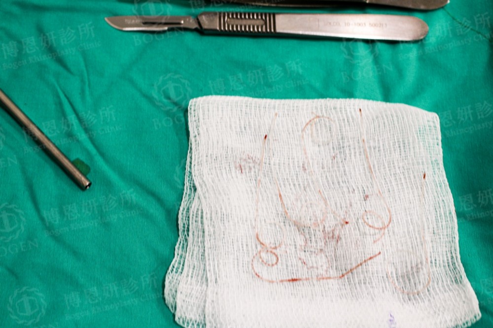 埋線隆鼻線材取出,鼻雕線取出,博恩妍