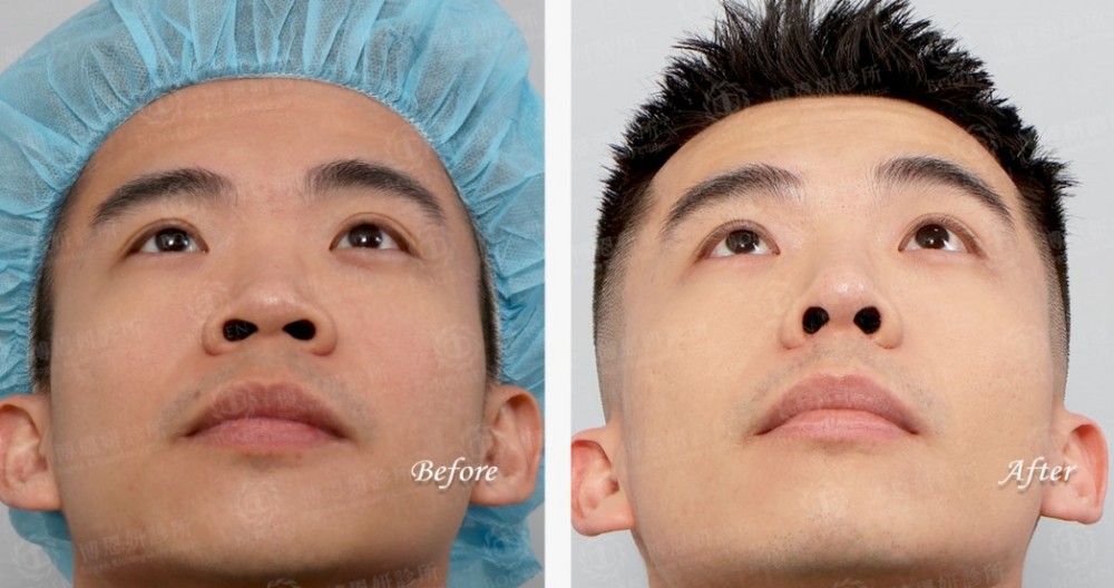 韓式隆鼻,結構式隆鼻,博恩妍