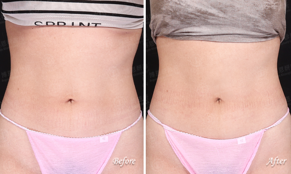 鈦特離子夾,鈦特離子夾緊致肚子肌膚,博恩妍