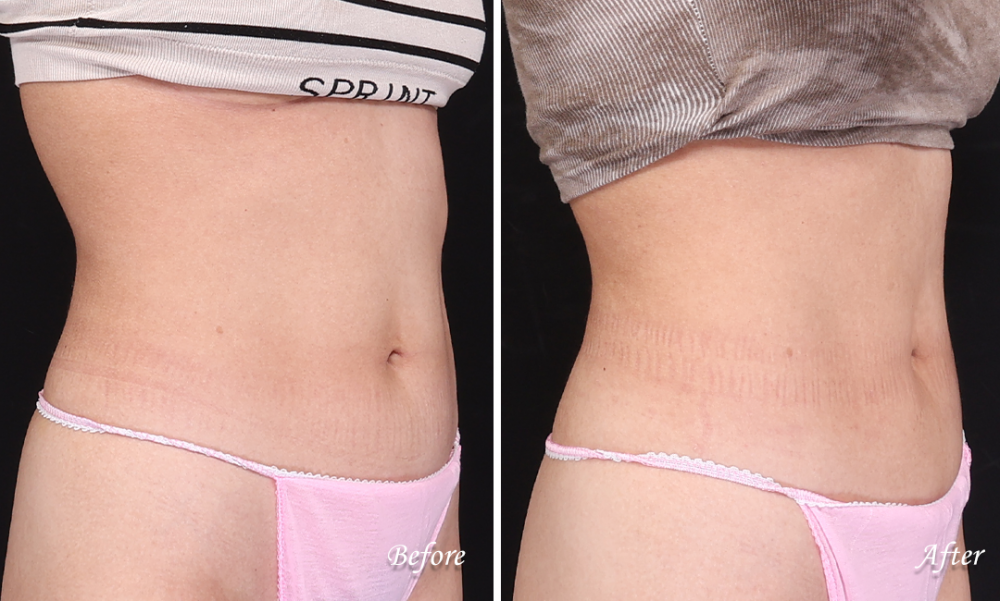 鈦特離子夾,鈦特離子夾緊致肚子肌膚,博恩妍