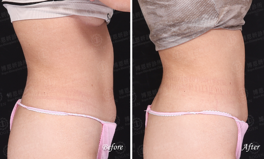 鈦特離子夾,鈦特離子夾緊致肚子肌膚,博恩妍