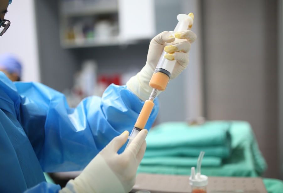 自體脂肪移植,自體脂肪純化,博恩妍