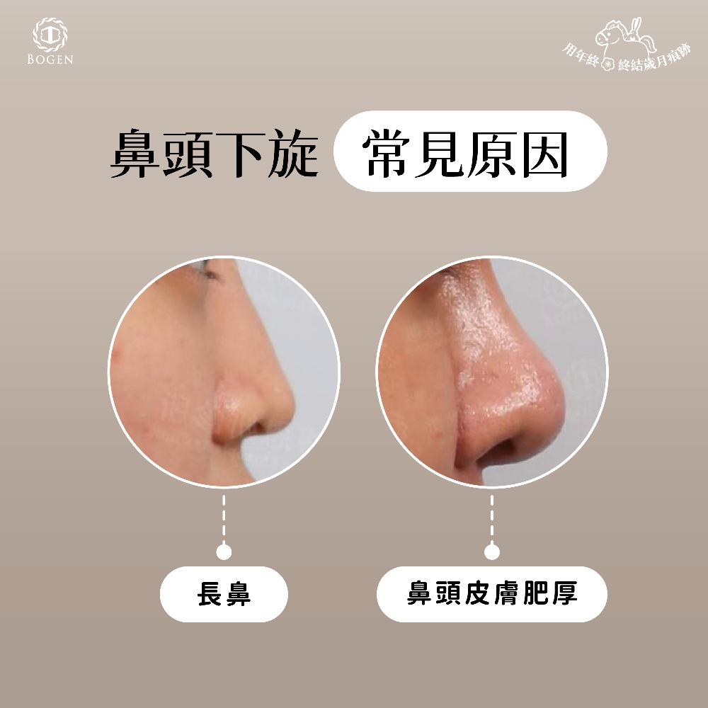 鼻頭下旋原因,鼻頭下旋,博恩妍