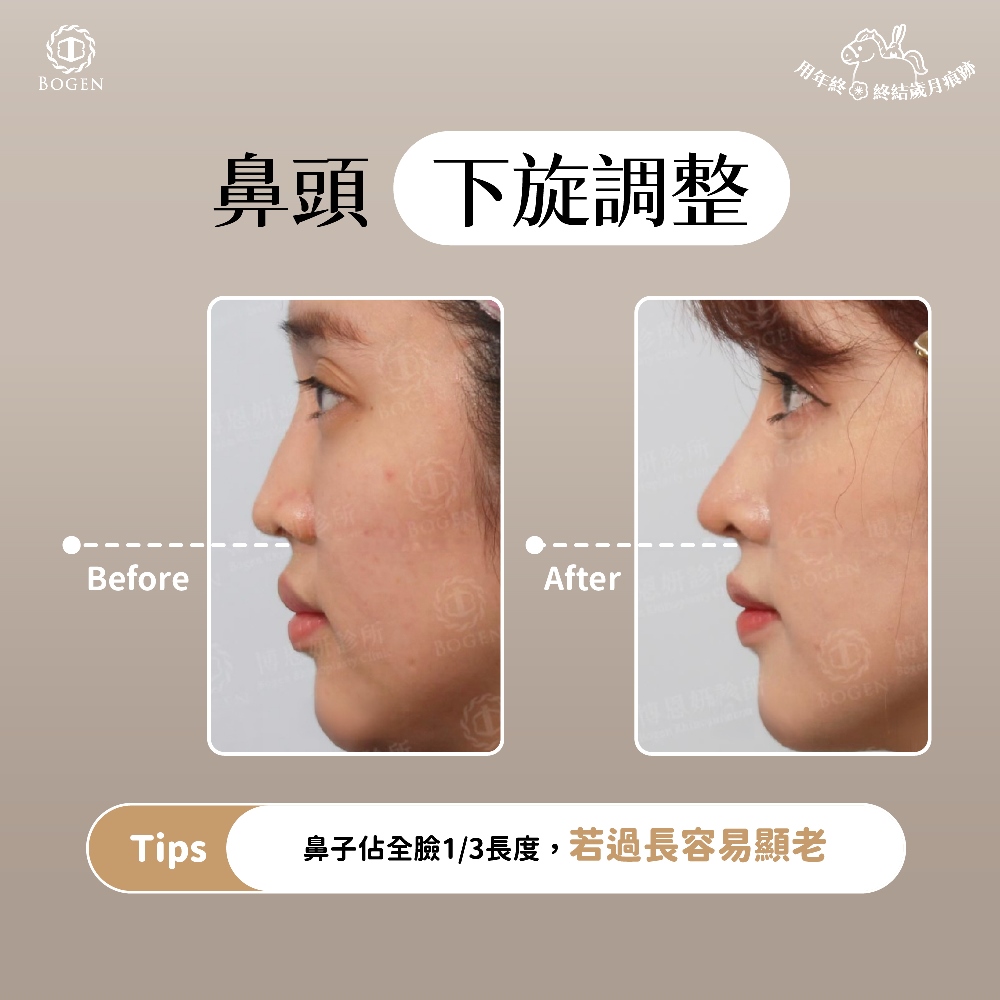 鼻頭下旋,鼻頭下旋調整,博恩妍