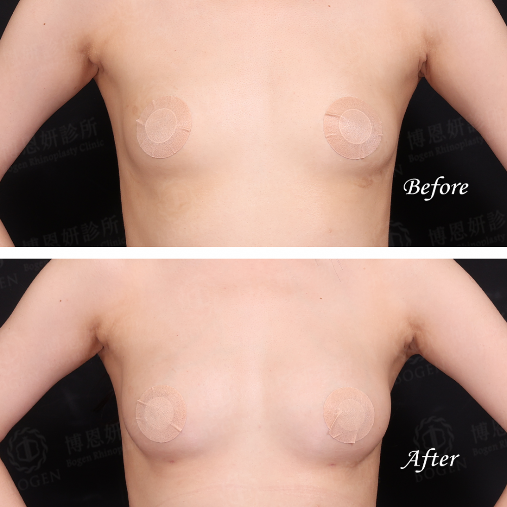 自體脂肪移植,自體脂肪移植胸部,自體脂肪移植隆乳,博恩妍
