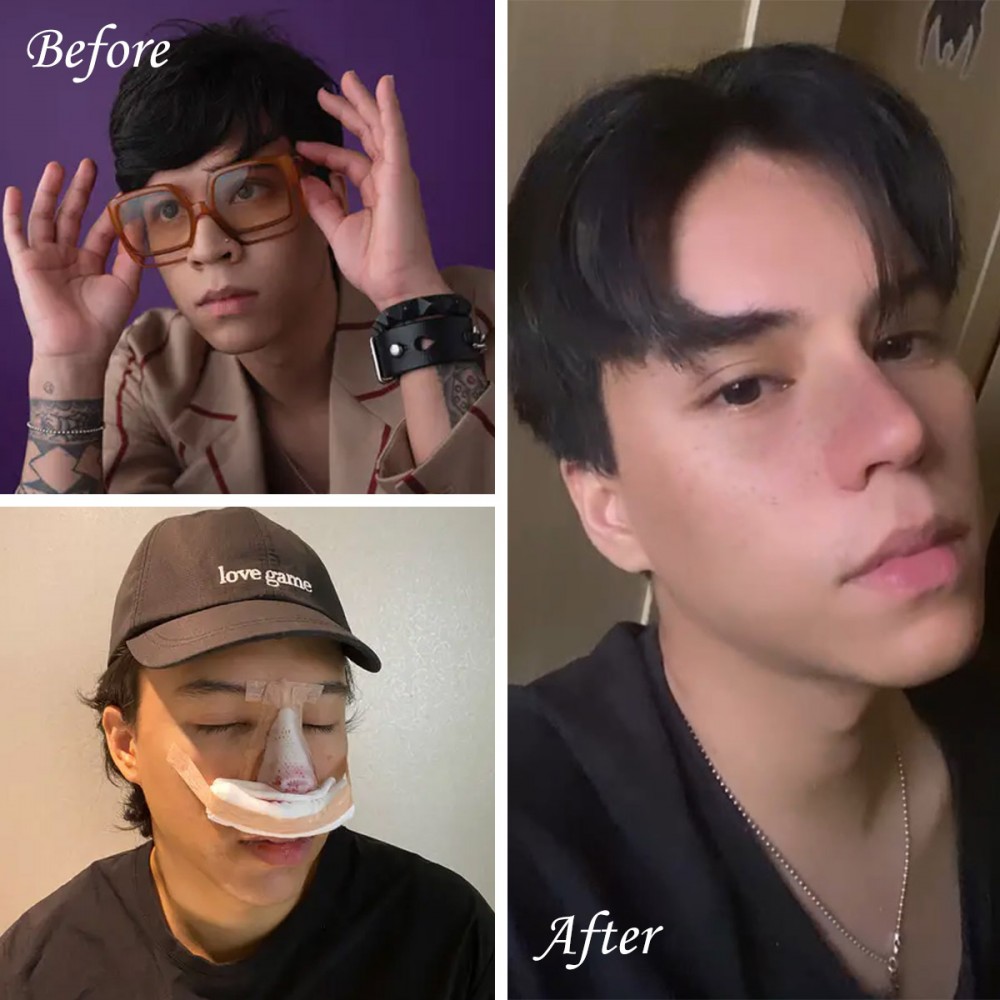 隆鼻恢復期,男性隆鼻,博恩妍