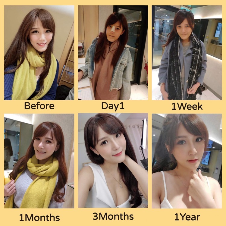 隆鼻恢復期,隆鼻,博恩妍