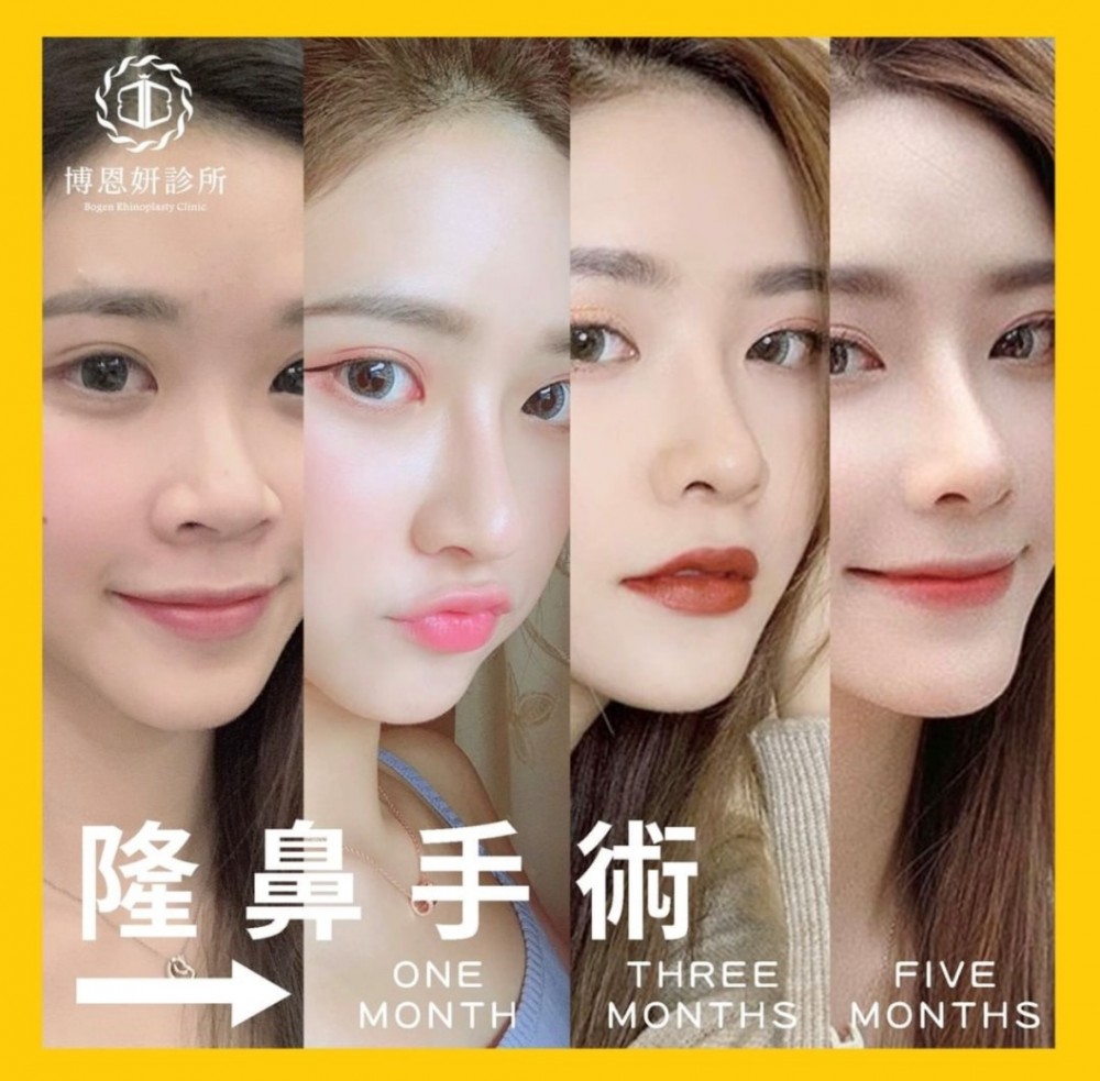 隆鼻恢復期,隆鼻,博恩妍