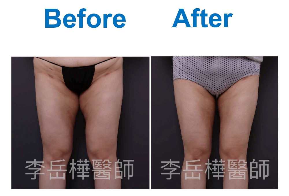 抽脂重修改善凹凸不平,抽脂重修,二次抽脂,博恩妍