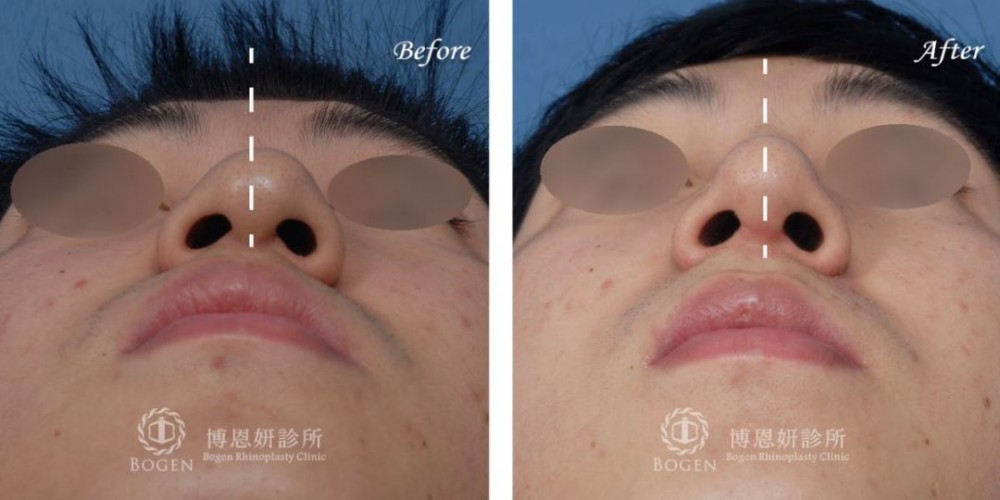鼻中膈彎曲手術,歪鼻手術,功能性鼻整型手術,博恩妍