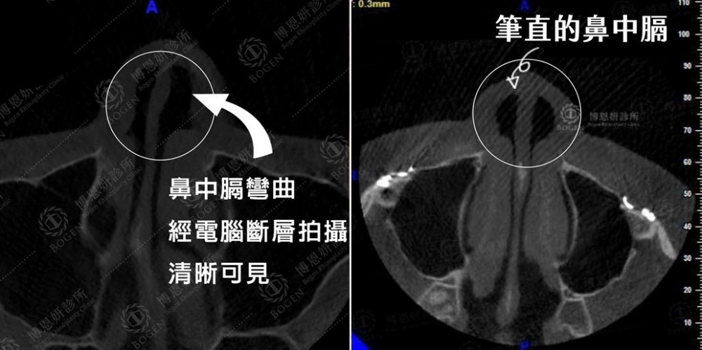 鼻中膈彎曲手術,歪鼻手術,功能性鼻整型手術,博恩妍