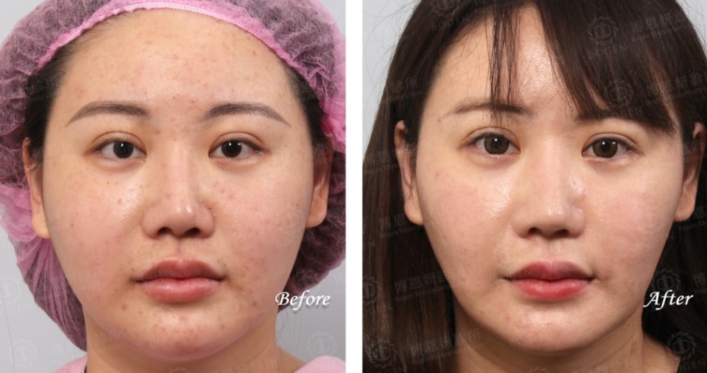 卡麥拉隆鼻,鼻重修,博恩妍