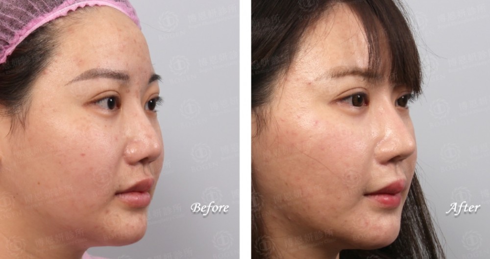 卡麥拉隆鼻,鼻重修,博恩妍