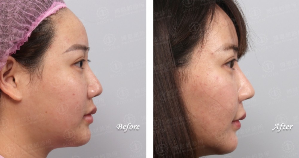 卡麥拉隆鼻,鼻重修,博恩妍