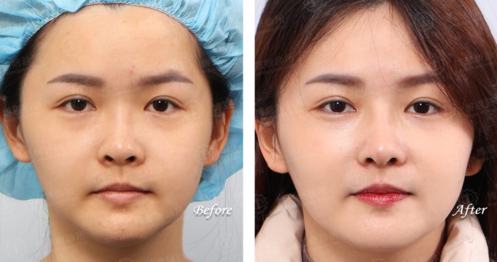 卡麥拉隆鼻,隆鼻,博恩妍