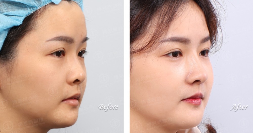 卡麥拉隆鼻,隆鼻,博恩妍