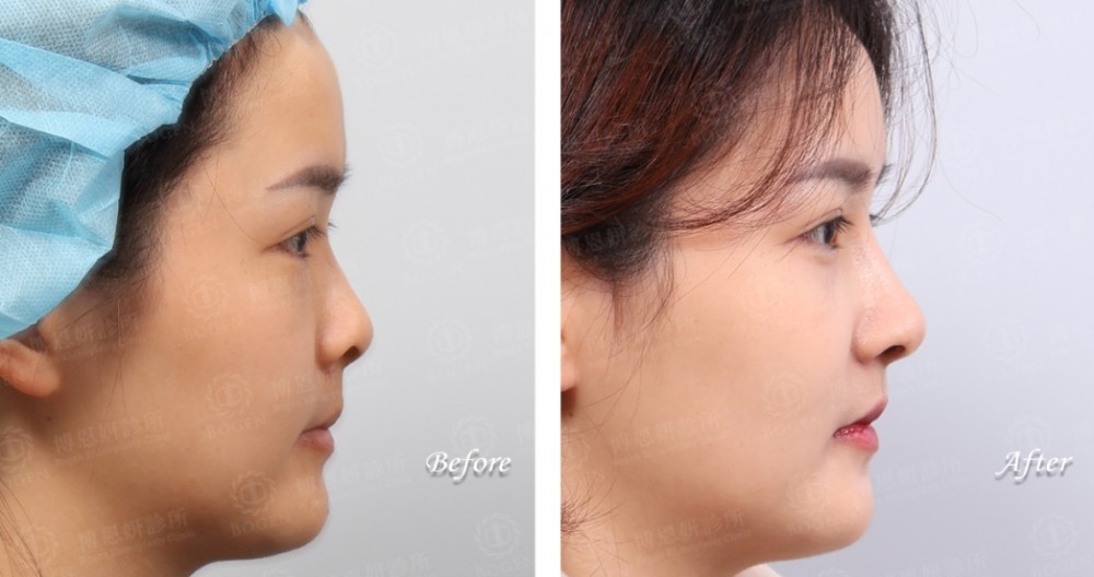 卡麥拉隆鼻,隆鼻,博恩妍