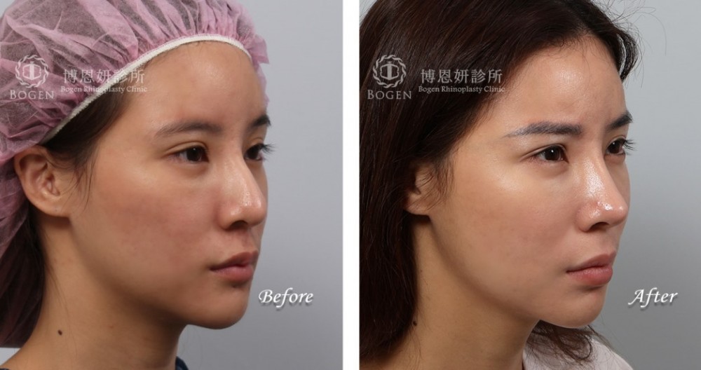 卡麥拉隆鼻,鼻重修,博恩妍