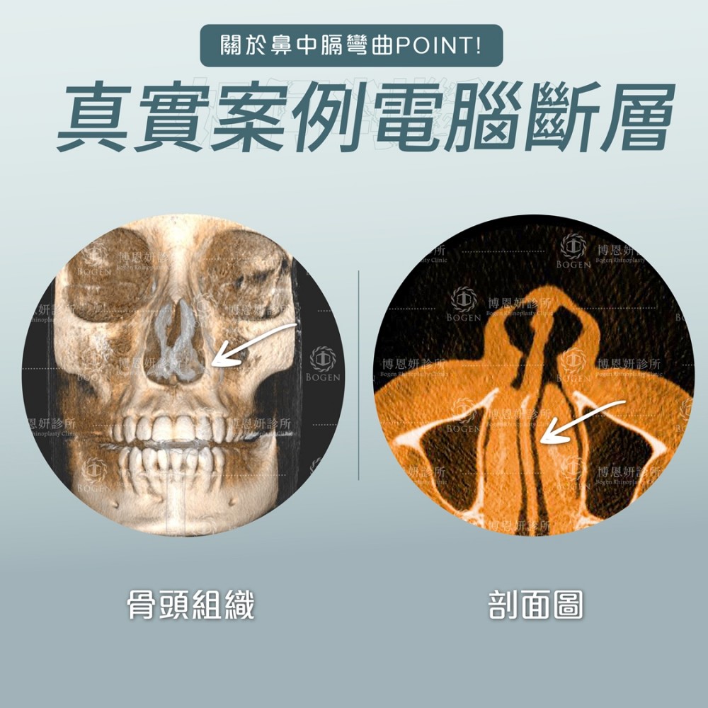 3D電腦斷層評估鼻中膈彎曲,鼻中膈彎曲,博恩妍