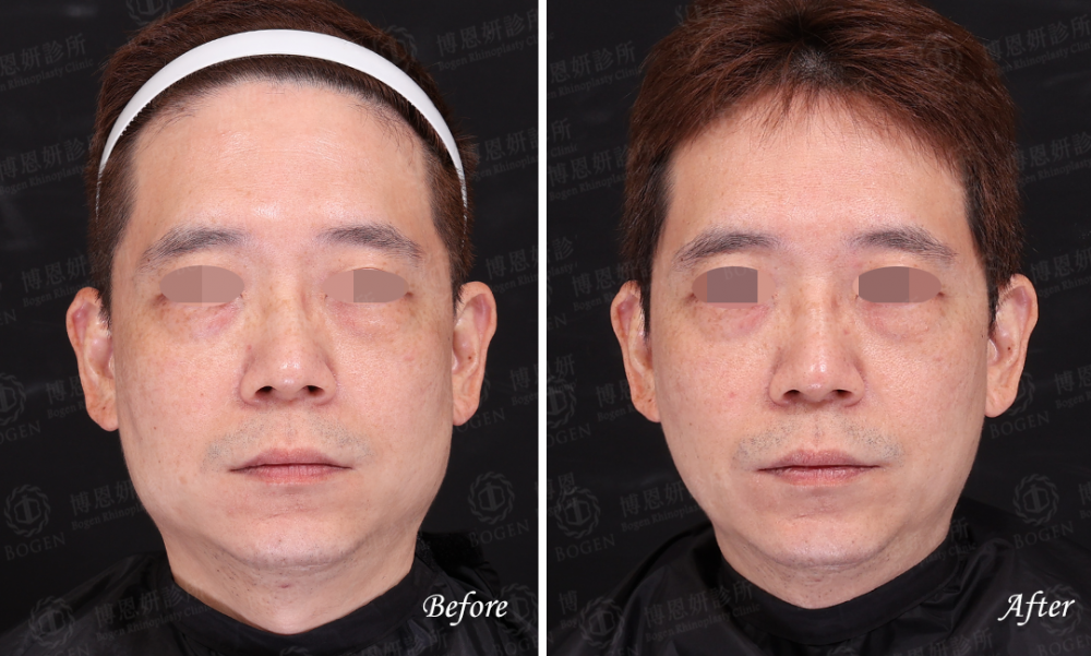 咀嚼肌肉毒,肉毒瘦小臉,博恩妍