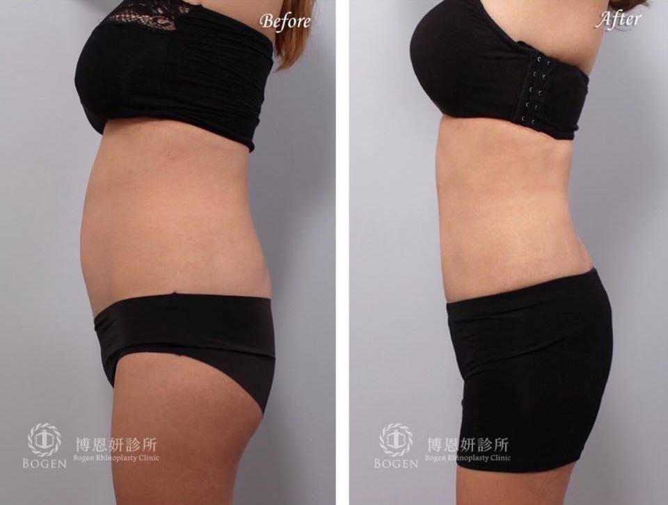 腹部抽脂,瘦小腹,博恩妍
