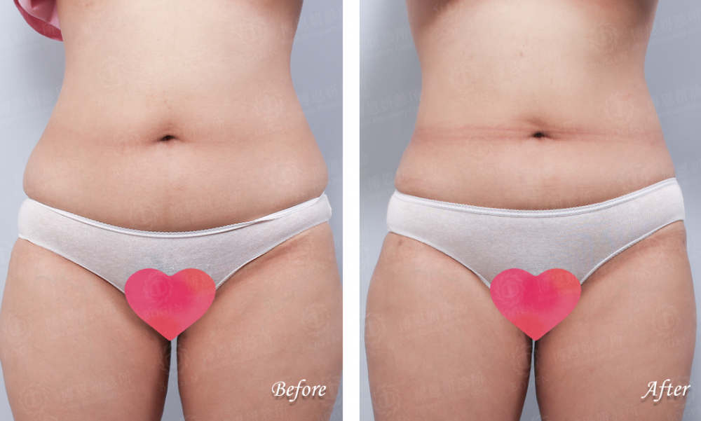 腹部抽脂,瘦小腹,博恩妍