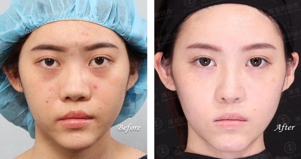 fitme完形美,隆鼻手術,隆鼻,博恩妍