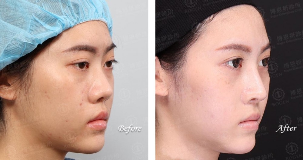 fitme完形美,隆鼻手術,隆鼻,博恩妍