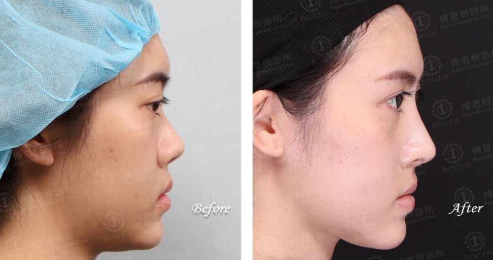 fitme完形美,隆鼻手術,隆鼻,博恩妍