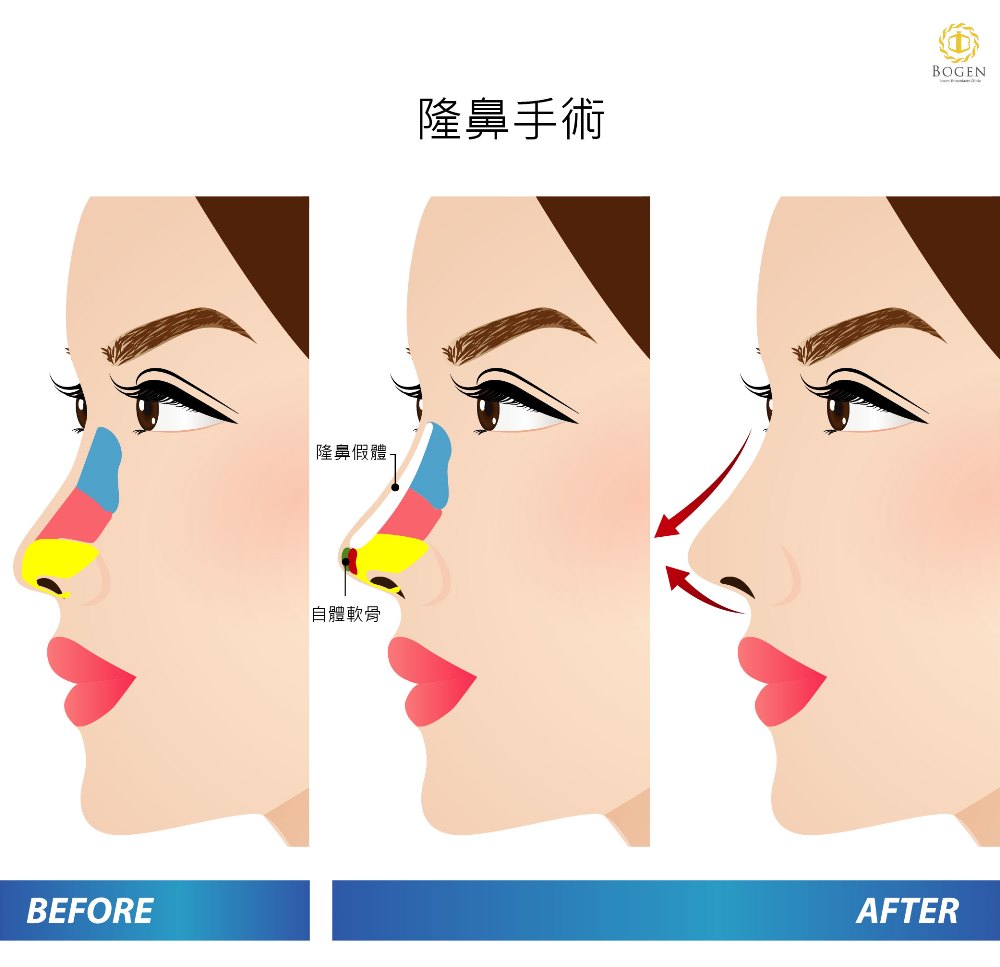 香港隆鼻材質,香港隆鼻手術,香港隆鼻,博恩妍