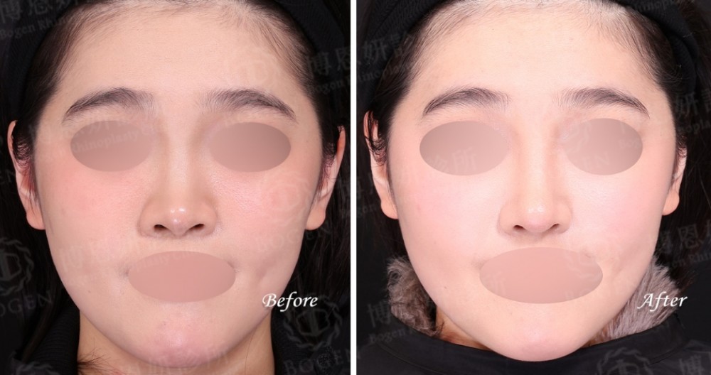 fitme完形美,隆鼻手術,隆鼻,博恩妍