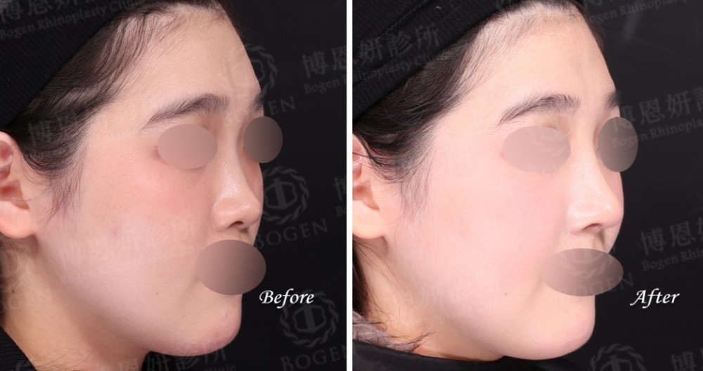 fitme完形美,隆鼻手術,隆鼻,博恩妍