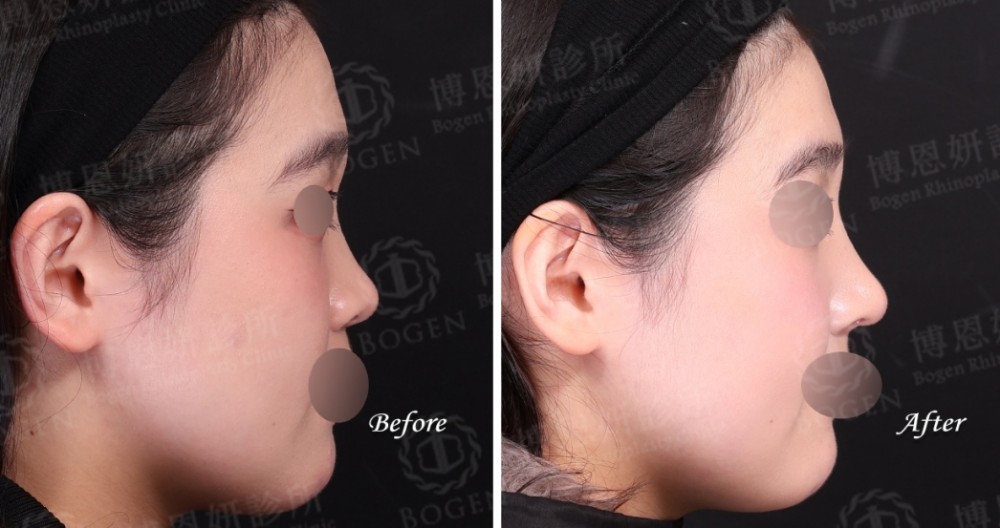 fitme完形美,隆鼻手術,隆鼻,博恩妍