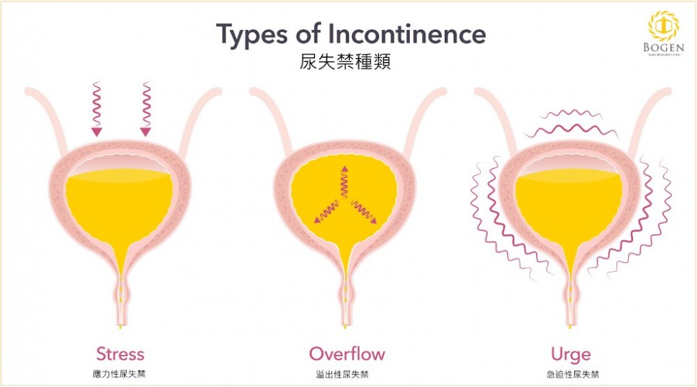 尿失禁種類,應力性尿失禁,溢出性尿失禁,急迫性尿失禁,博恩妍