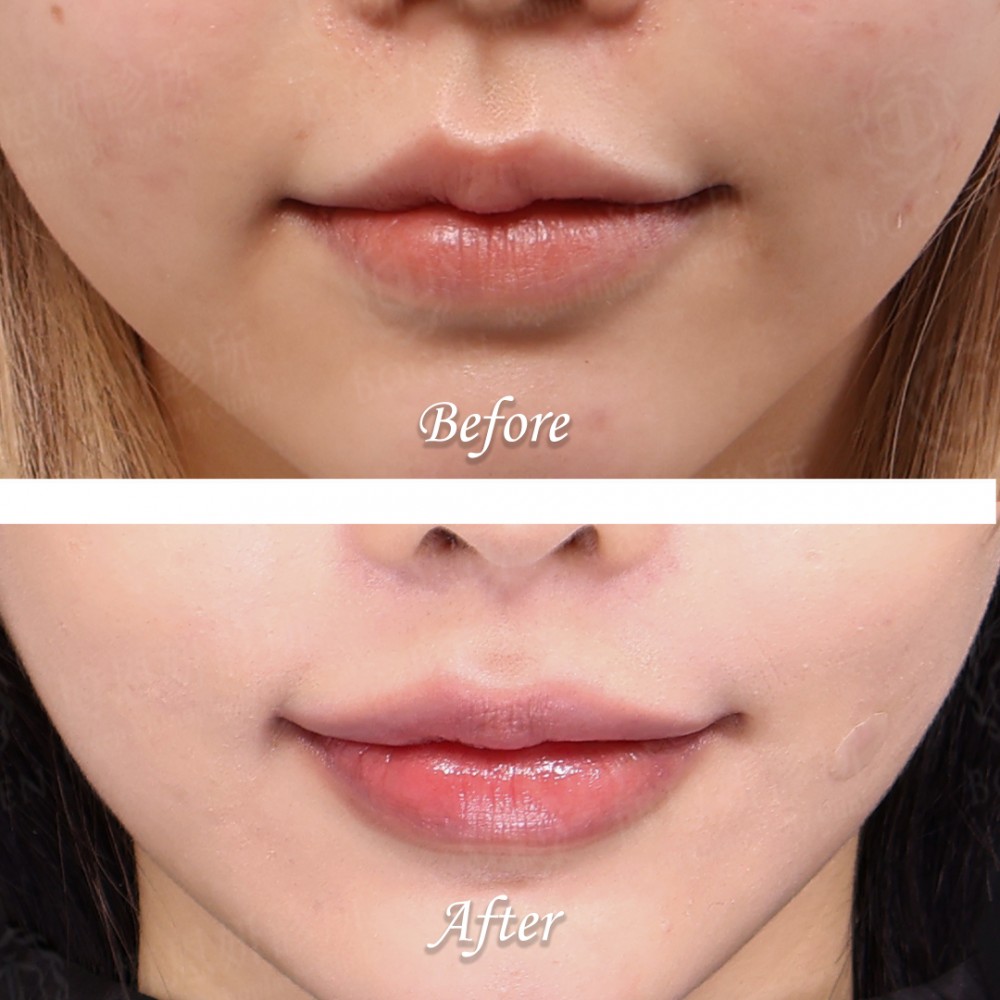 玻尿酸豐唇心得,玻尿酸豐唇案例,玻尿酸豐唇,博恩妍