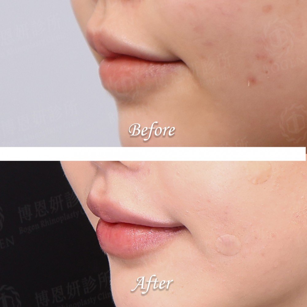 玻尿酸豐唇心得,玻尿酸豐唇案例,玻尿酸豐唇,博恩妍