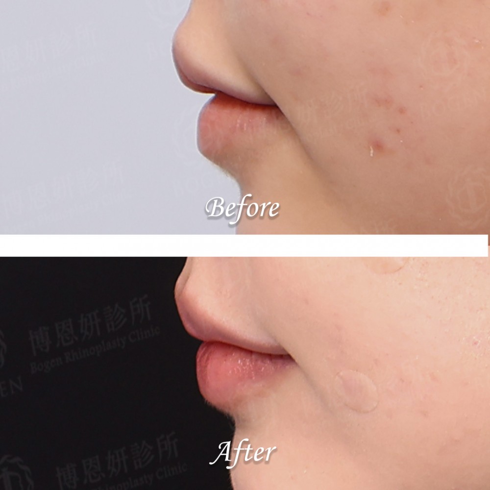 玻尿酸豐唇心得,玻尿酸豐唇案例,玻尿酸豐唇,博恩妍