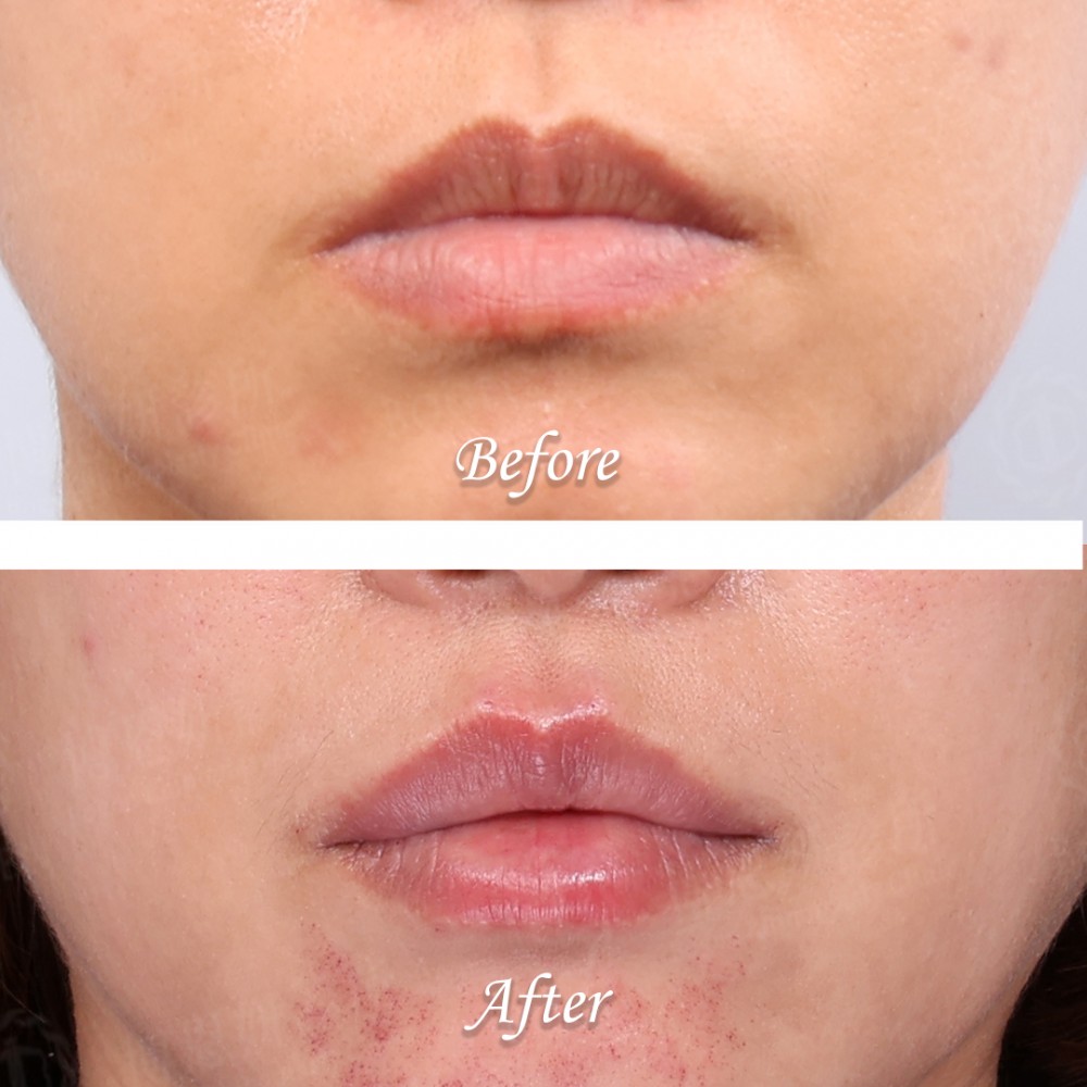 玻尿酸豐唇心得,玻尿酸豐唇案例,玻尿酸豐唇,博恩妍