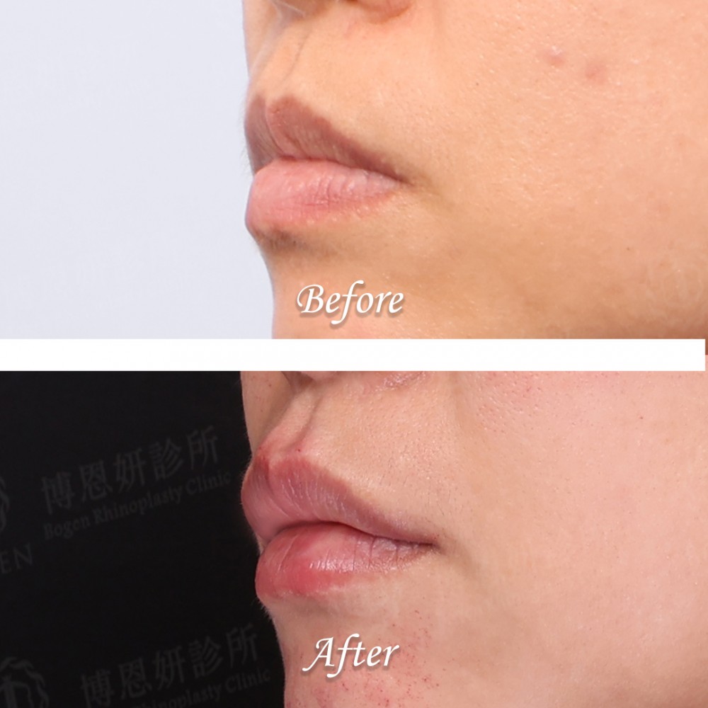 玻尿酸豐唇心得,玻尿酸豐唇案例,玻尿酸豐唇,博恩妍