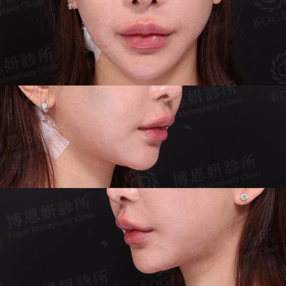 玻尿酸豐唇心得,玻尿酸豐唇案例,玻尿酸豐唇,博恩妍