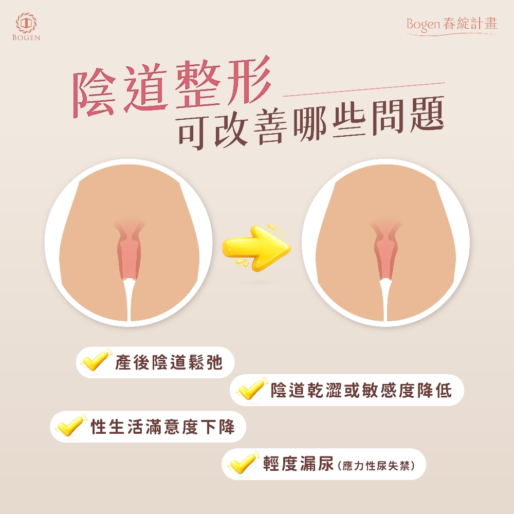 陰道整形,陰道整形改善那些問題,博恩妍